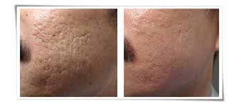 Ανάπλαση προσώπου σε έναν άντρα