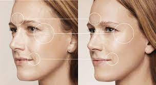 Μέρη που εισάγεται το υαλουρονικό οξύ στο πρόσωπο